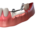 Расщепление гребня