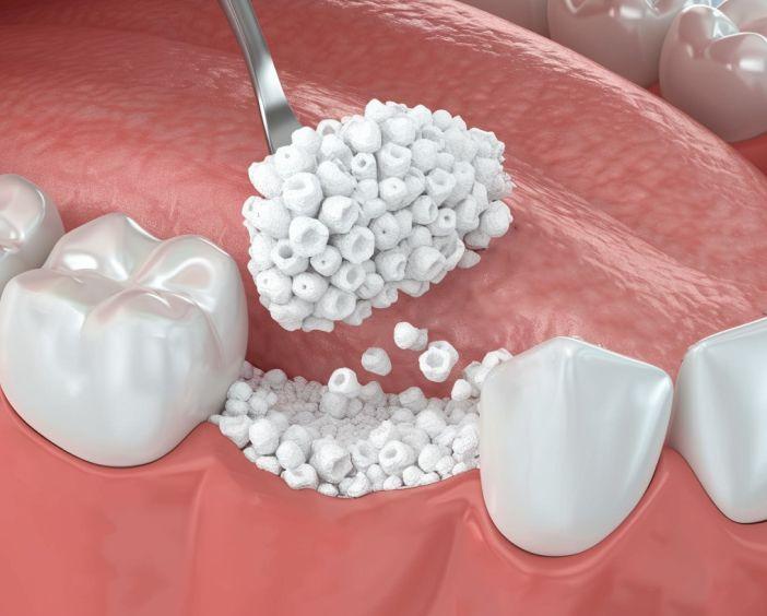 Синтетические материалы (биокерамика: фосфаты кальция, гидроксиапатит)