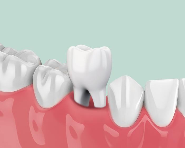 Удаление зубов любой сложности