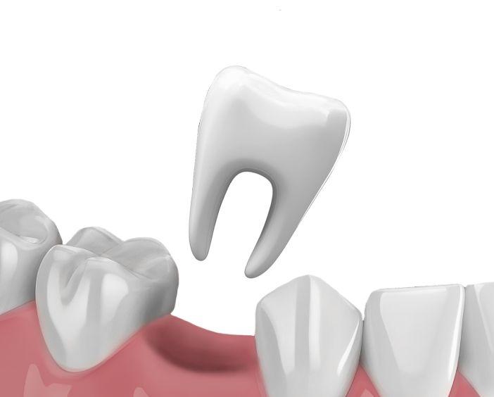 Удаление зубов