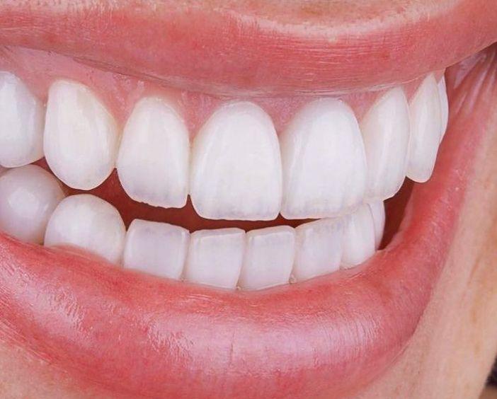 Ультратонкие виниры