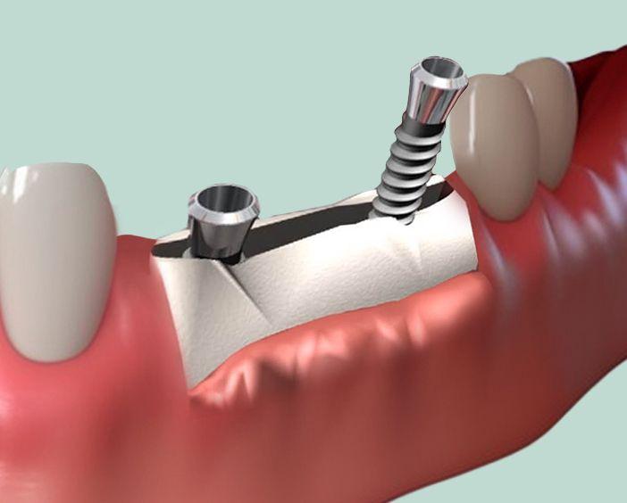 Увеличение ширины альвеолярного гребня (расщепление гребня)