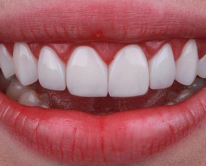 Временные виниры