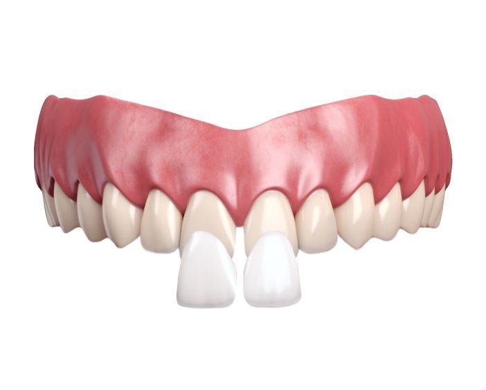 Закрытие диастем и трем