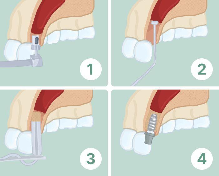 Закрытый синус-лифтинг