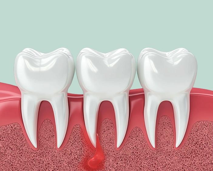 Зубосохраняющие операции